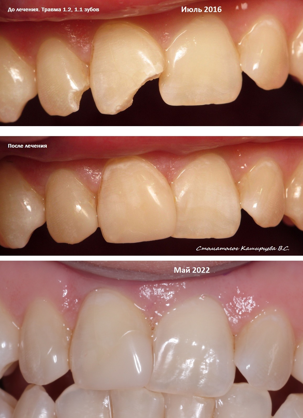 Типы реставраций. Реставрация зубов до и после.