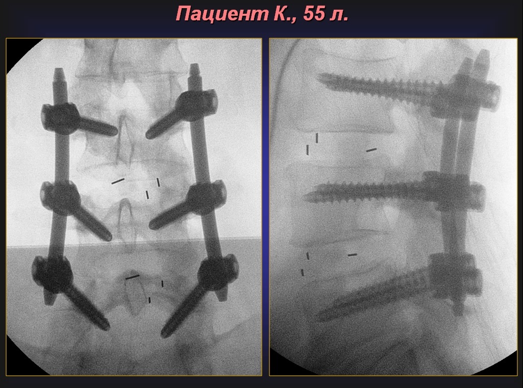 Тпф позвоночника. Межпозвонковый дисковый стеноз неврального канала. Сужение канала позвоночника поясничного отдела операция.