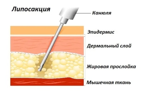Липосакция