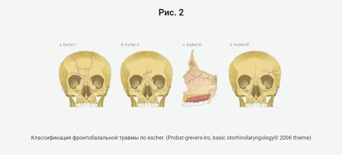 Виды переломов черепа