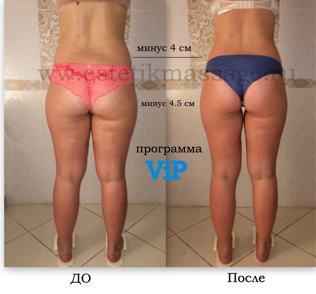 Кто похудел с баночным массажем быстро