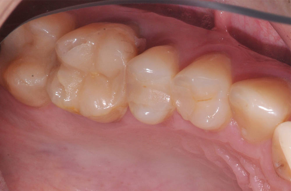 Замена сколовшейся пломбы на жевательном зубе циркониевой коронкой