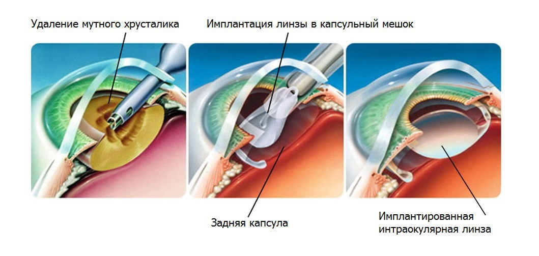 Удаление катаракты реабилитация. Факоэмульсификация катаракты с имплантацией интраокулярной линзы. Операция ультразвуковая факоэмульсификация катаракты. Факоэмульсификация катаракты этапы операции. Катаракта ФЭК этапы операции.