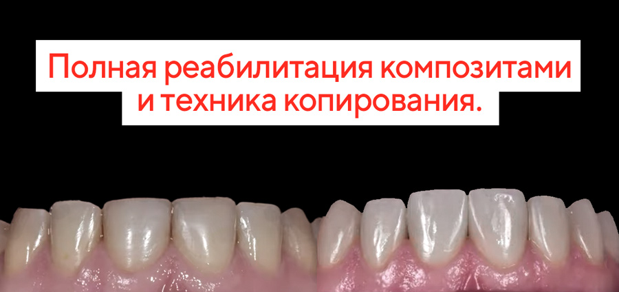 Полная реабилитация композитами и техника копирования.