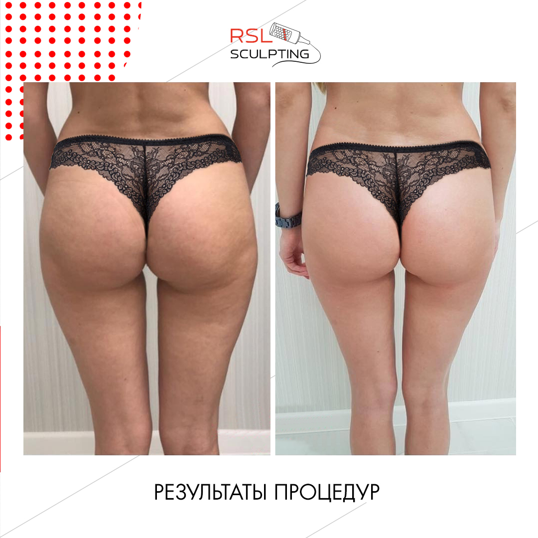 Ягодицы и бёдра до и после курса РСЛ-скульптурирования
