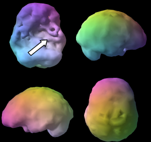 Визуализация мозга с ЧМТ