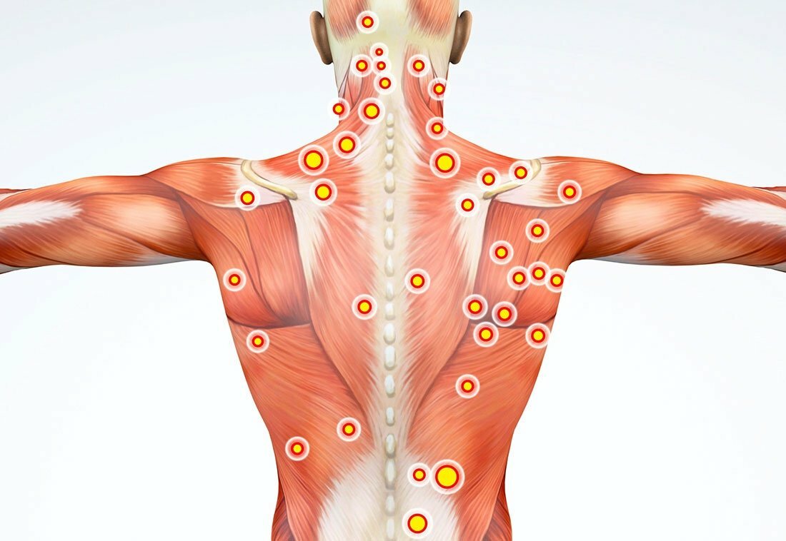 Триггерные точки. Миофасциальный релиз триггерные точки. Миофасциальный массаж триггерных точек. Триггерные точки на спине.