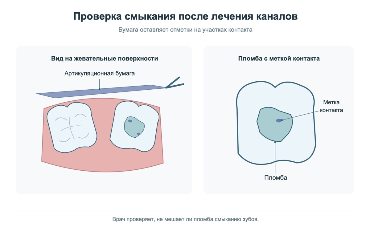 Проверка смыкания после лечения корневых каналов: метка контакта на пломбе