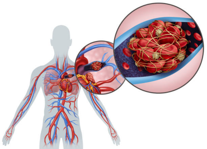 Тромбоэмболия легочной артерии. Тромб легочной артерии тромбоэмболия. Тромбоэмболия легочной артерии (Тэла). Тромболия легочной артерии