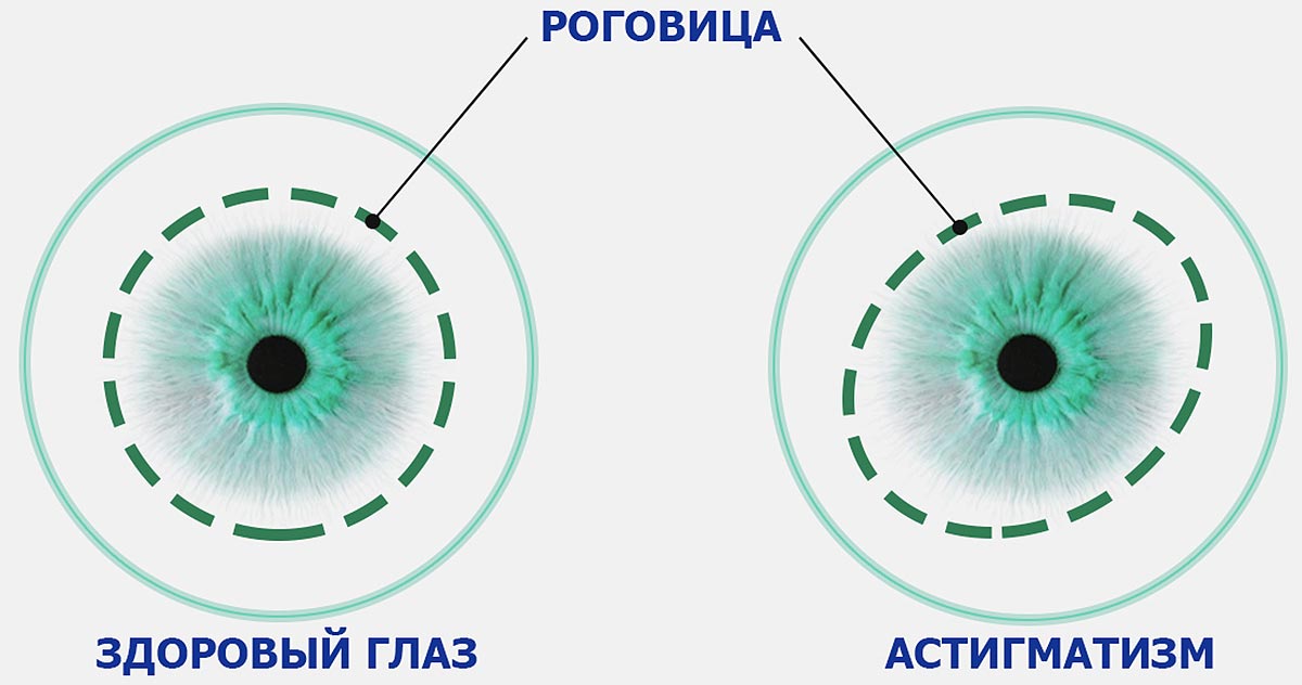 Ряд ряды глаз глаза. Форма роговицы при астигматизме. Астигматизм схема глаза. Роговичный и хрусталиковый астигматизм. Роговица при астигматизме.