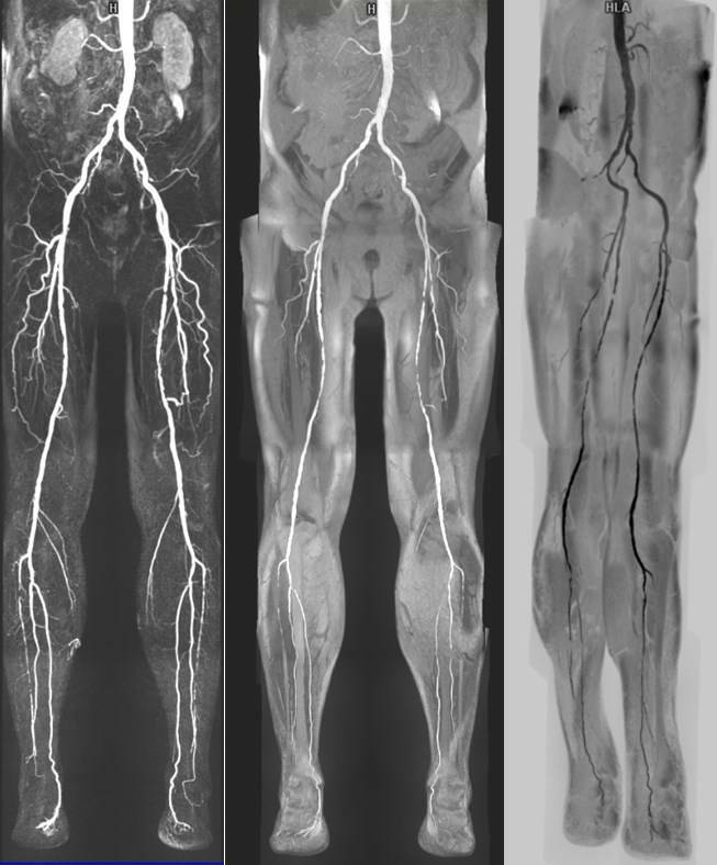 Контраст вены. Ангиография сосудов нижних конечностей атеросклероз. Кт флебография вен нижних конечностей. Ангиограмма сосудов нижних конечностей. Мрт ангиография артерий нижних конечностей.