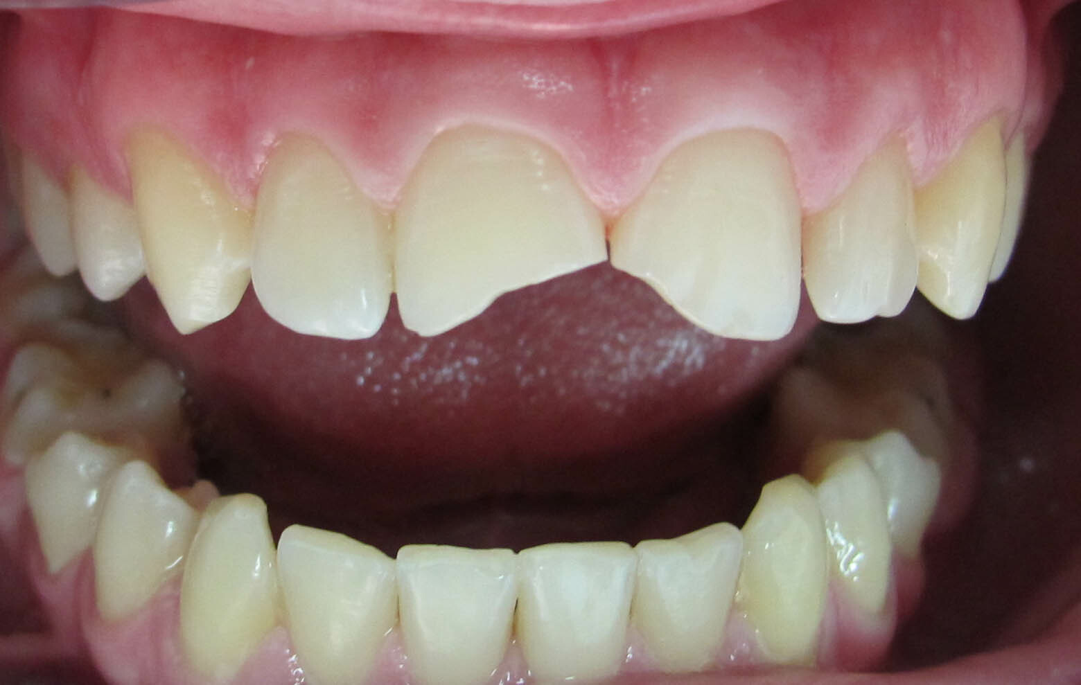 Отбеливание зубов - Стоматология Маэстро на Таганке