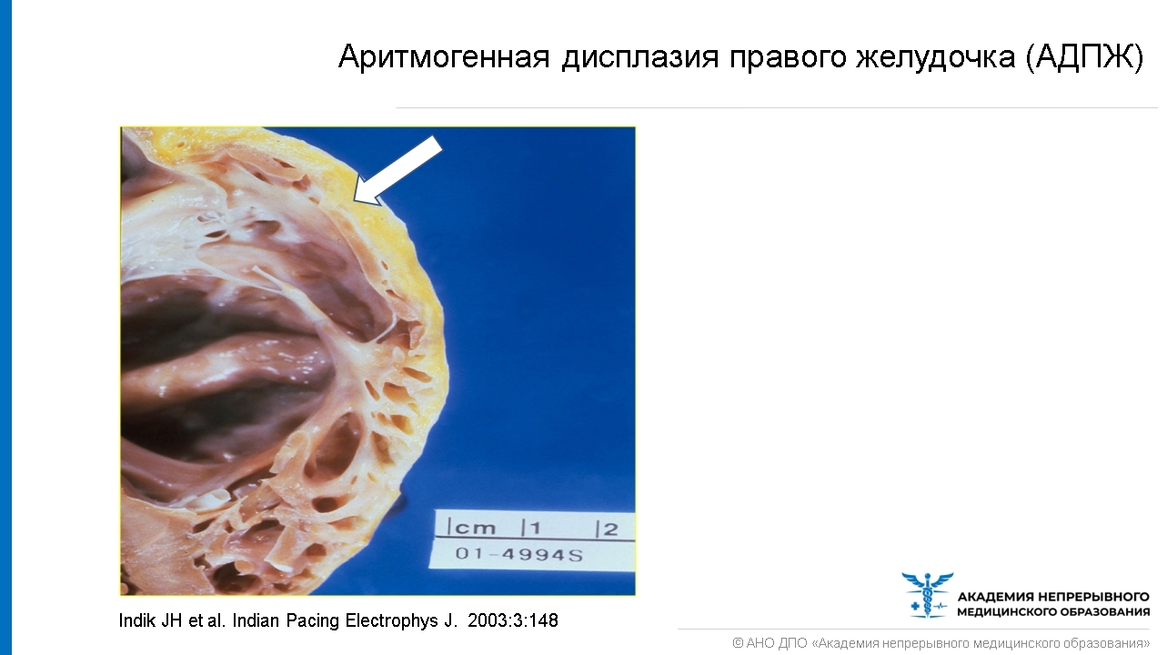 Патологическое спортивное сердце. Основные изменения