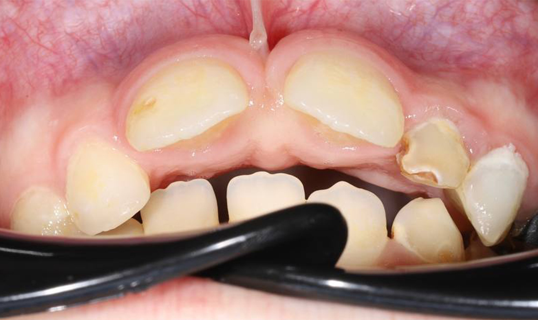 Лечение на съемной пластинке на верхнюю челюсть у ребенка 7 лет