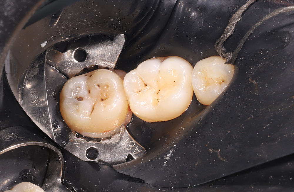 Устранение кариозного поражения зуба с применением коффердама и композитной реставрации