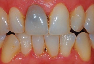 Причины потемнения зубов около десны