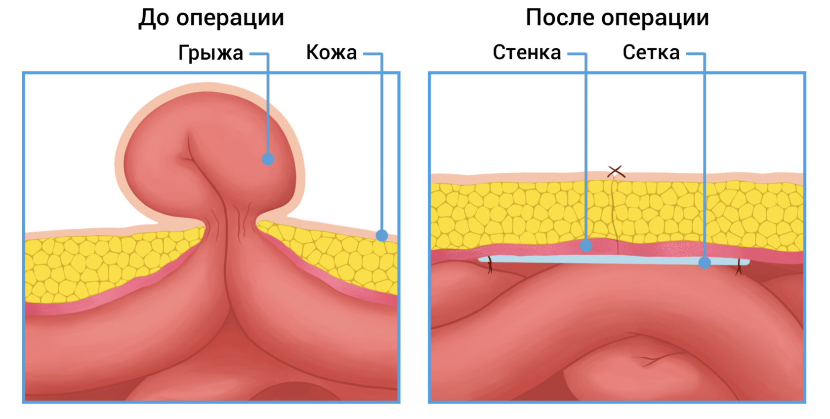 Пупочная грыжа у взрослых: симптомы и лечение