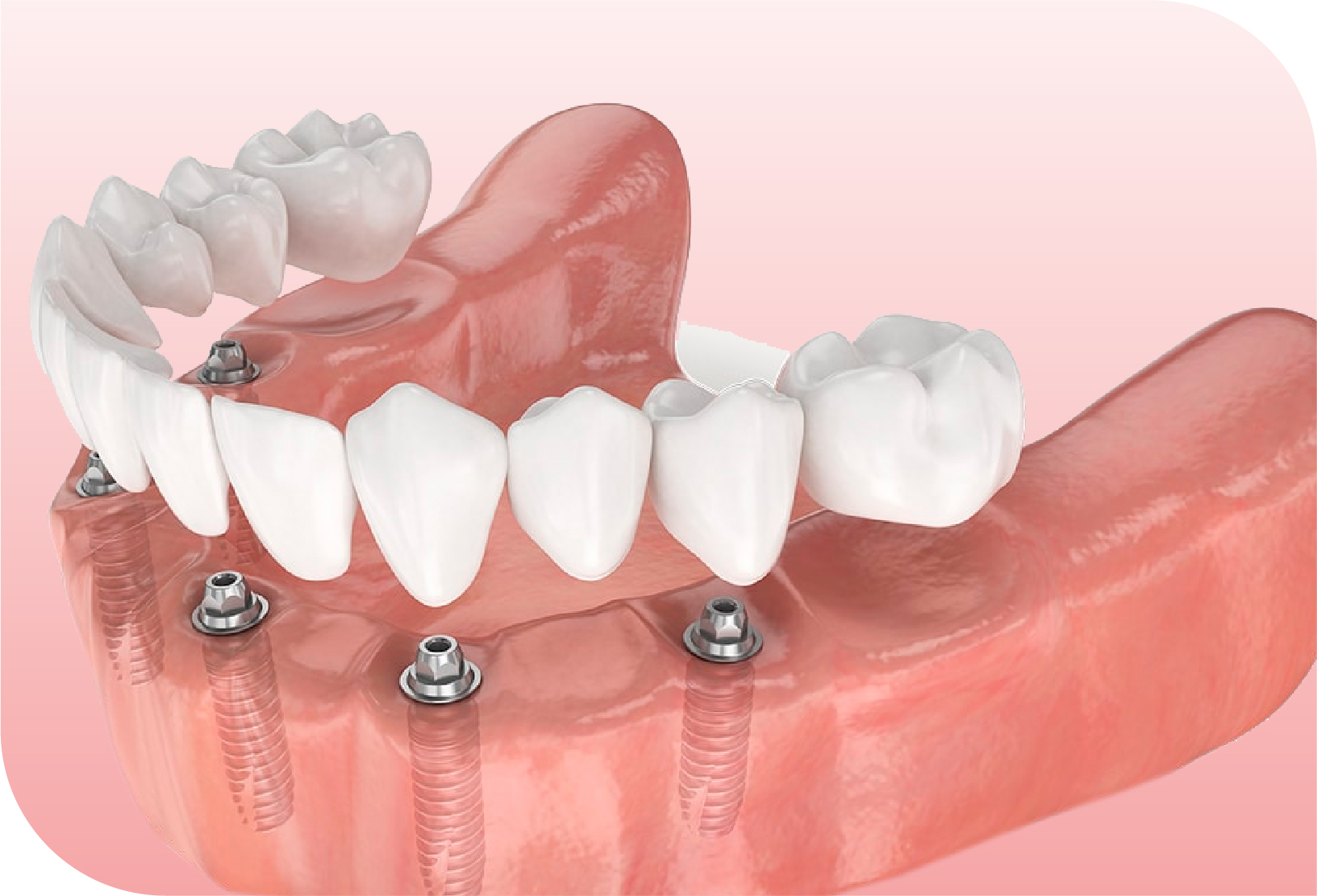 Несъемные зубные протезы на 4 имплантах