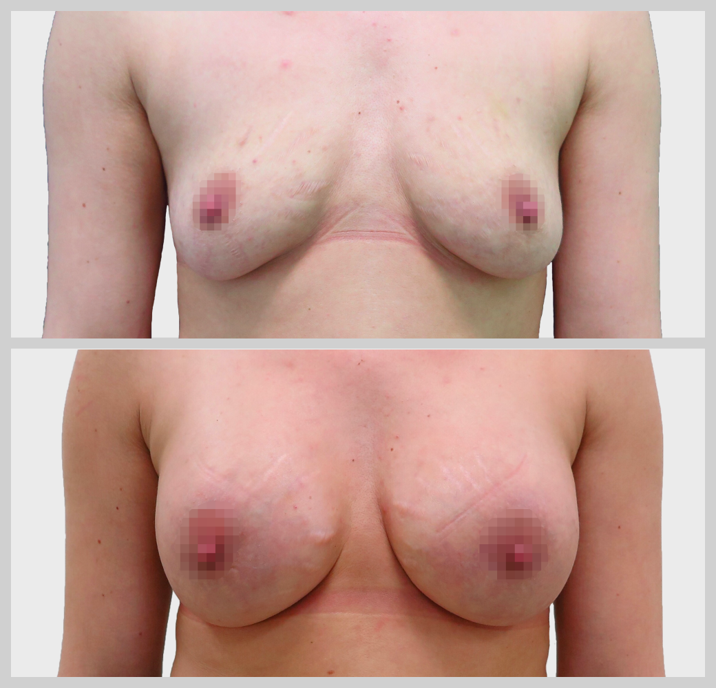 маммопластика увеличение груди импланты