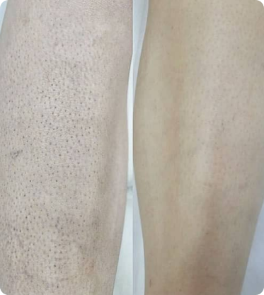 Лазерная эпиляция СПб