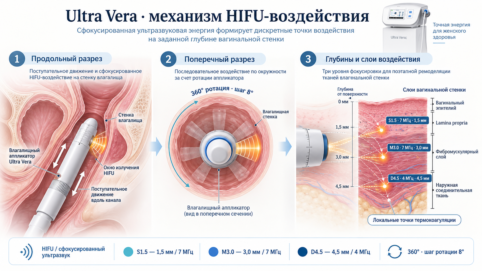 Ultra Vera — общая схема HIFU