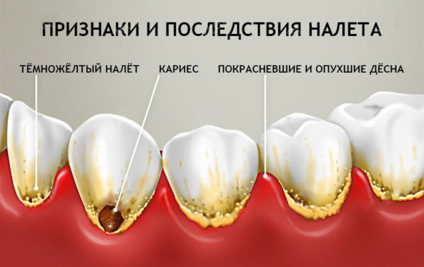 Кариес зубов фото до и после