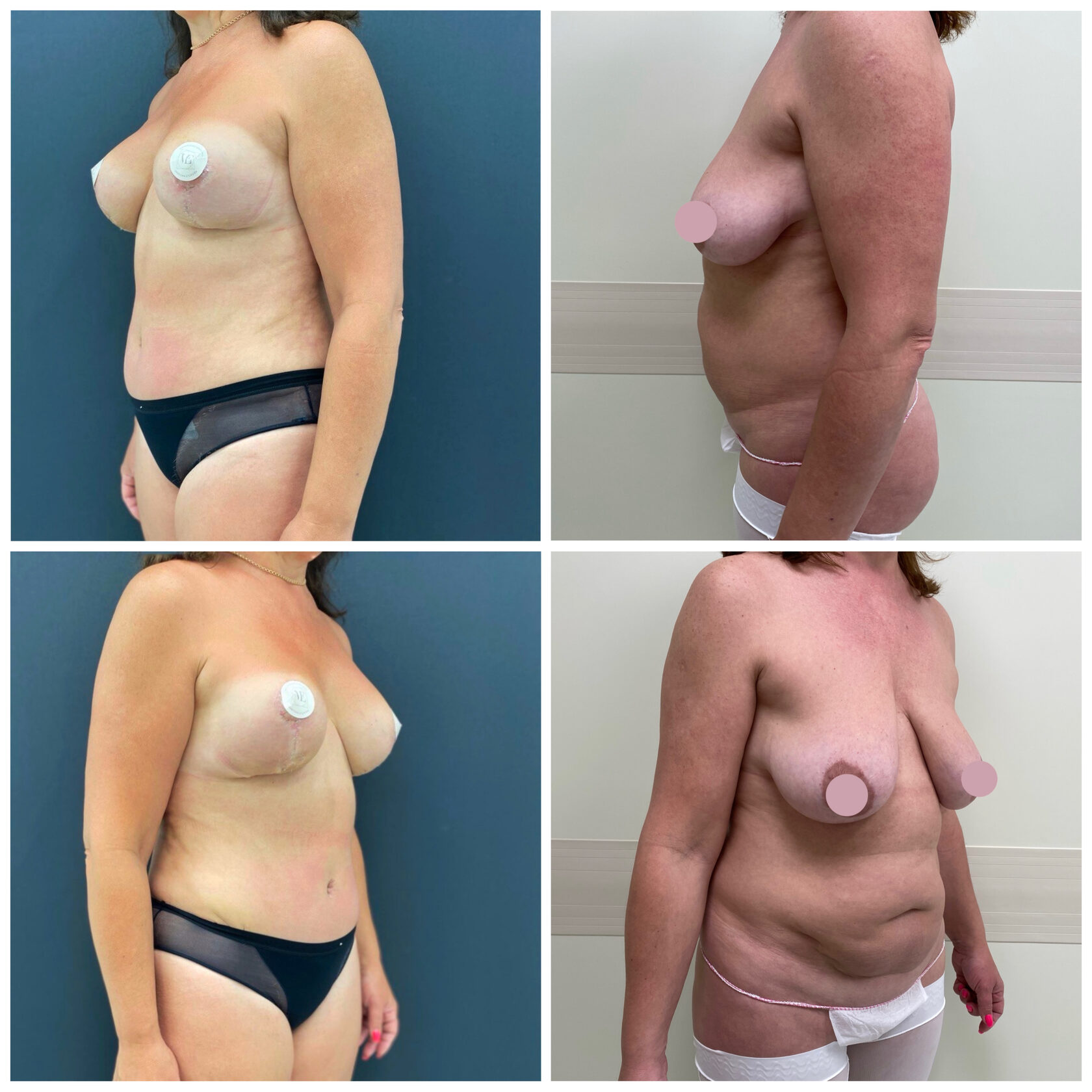 операция по подтяжке груди у женщин фото 69