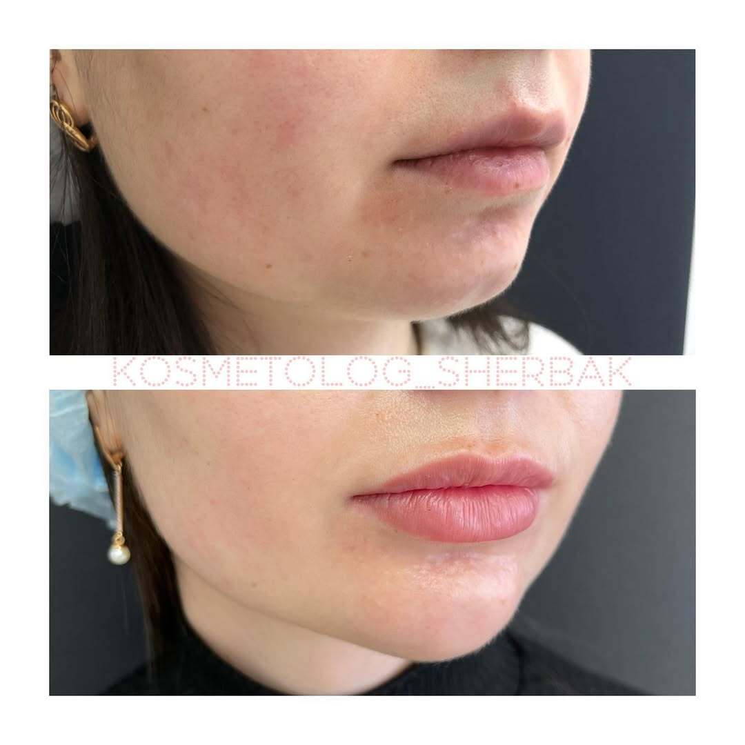 Контурная пластика лица в клинике PradusCOSMO, Санкт-Петербург. Естественный результат без эффекта переделанного лица