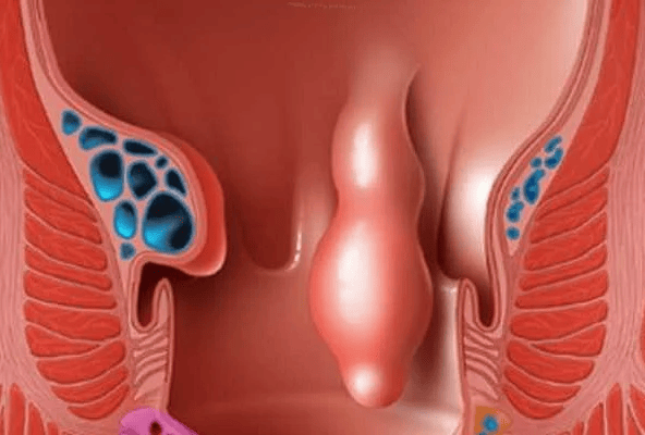 Что делать когда у вас папиллит анального канала