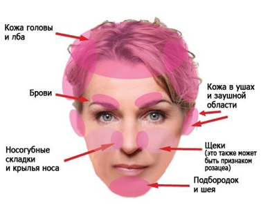 Себорея кожи головы: причины и симптомы жирной, сухой и смешанной, как лечить в домашних условиях