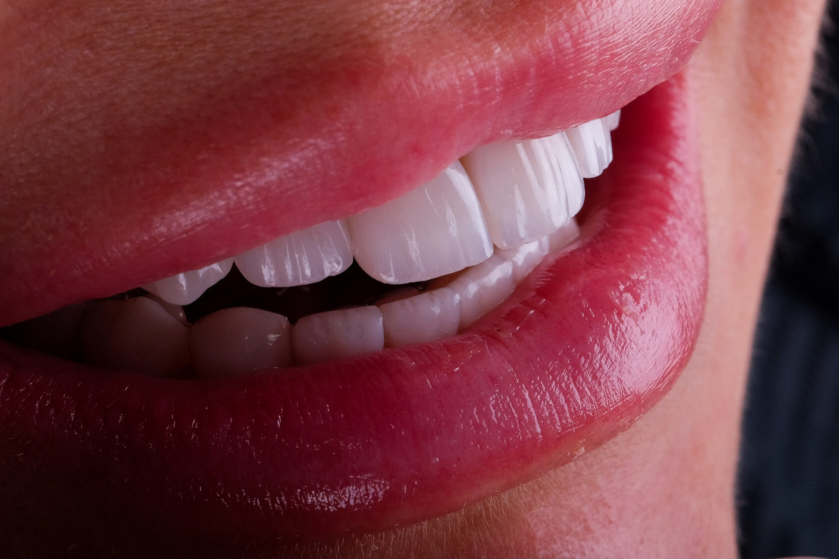 Композитные виниры в Екатеринбурге