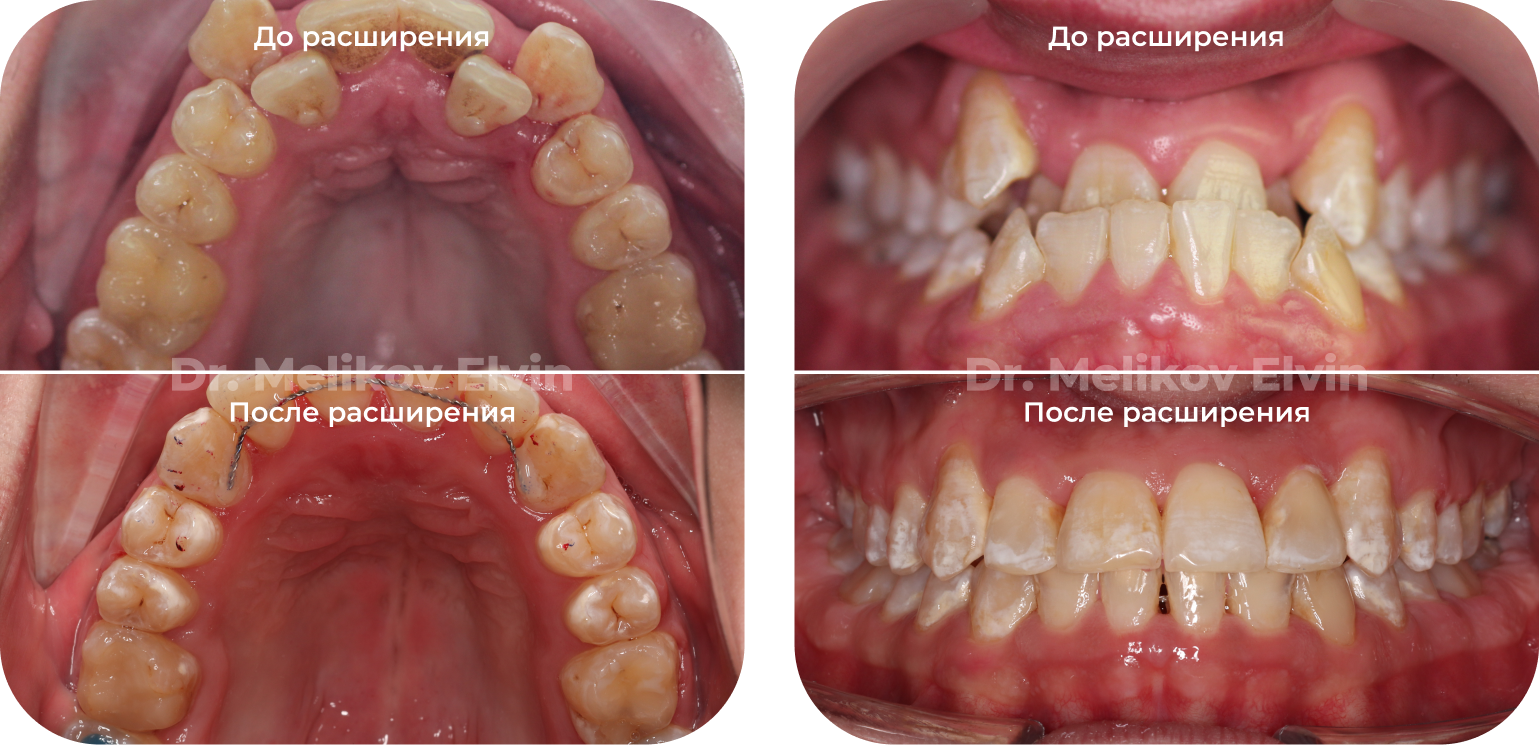 Фотографии прикуса до и после операции по расширению верхней челюсти.