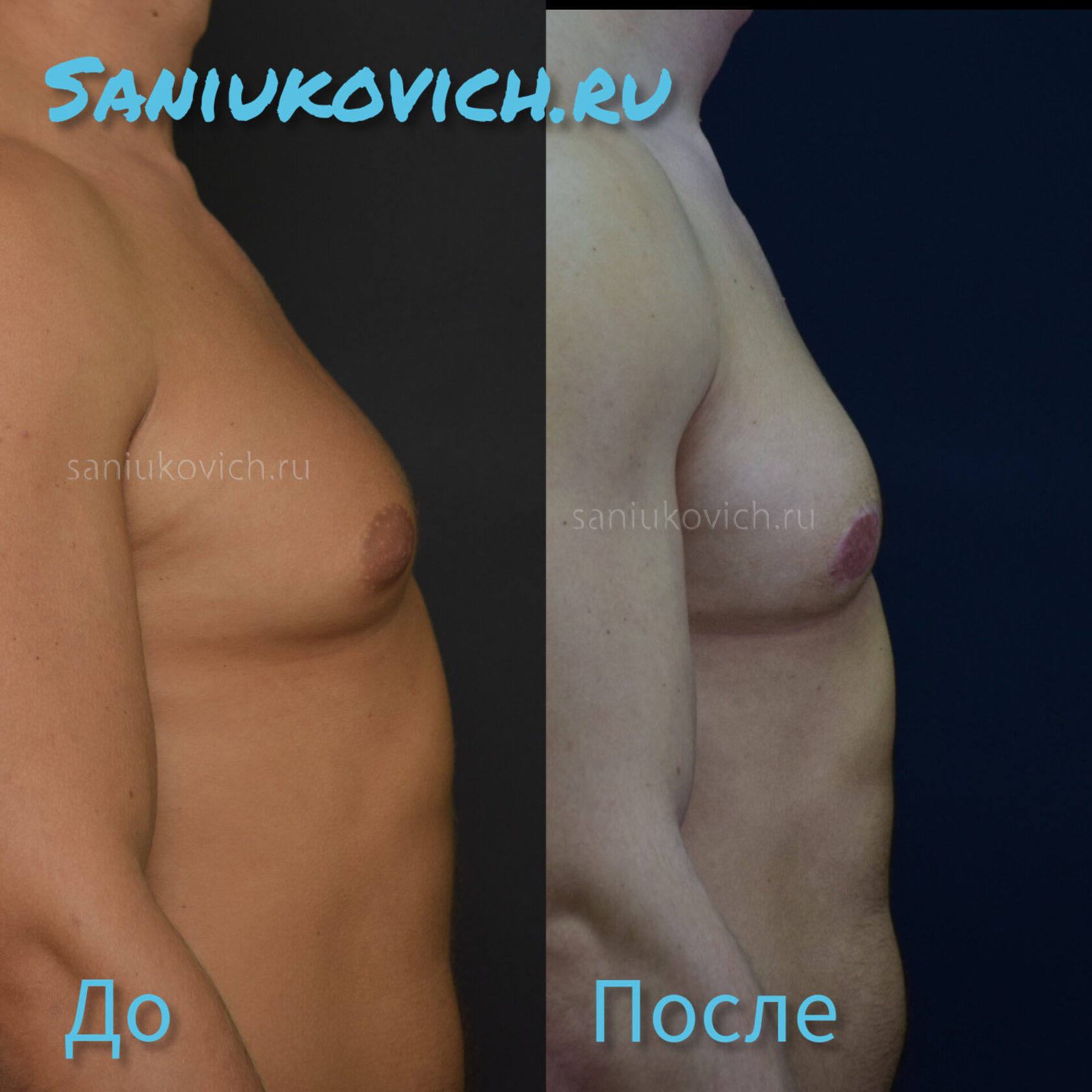 гормоны которые увеличивают грудь у мужчин фото 6