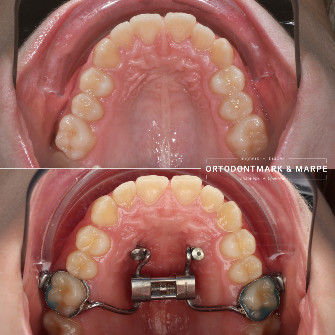 MARPE case result 3