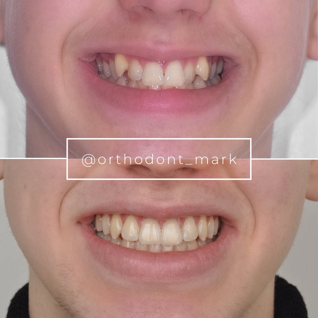 Midline and Smile Arc Restored Through Arch Expansion