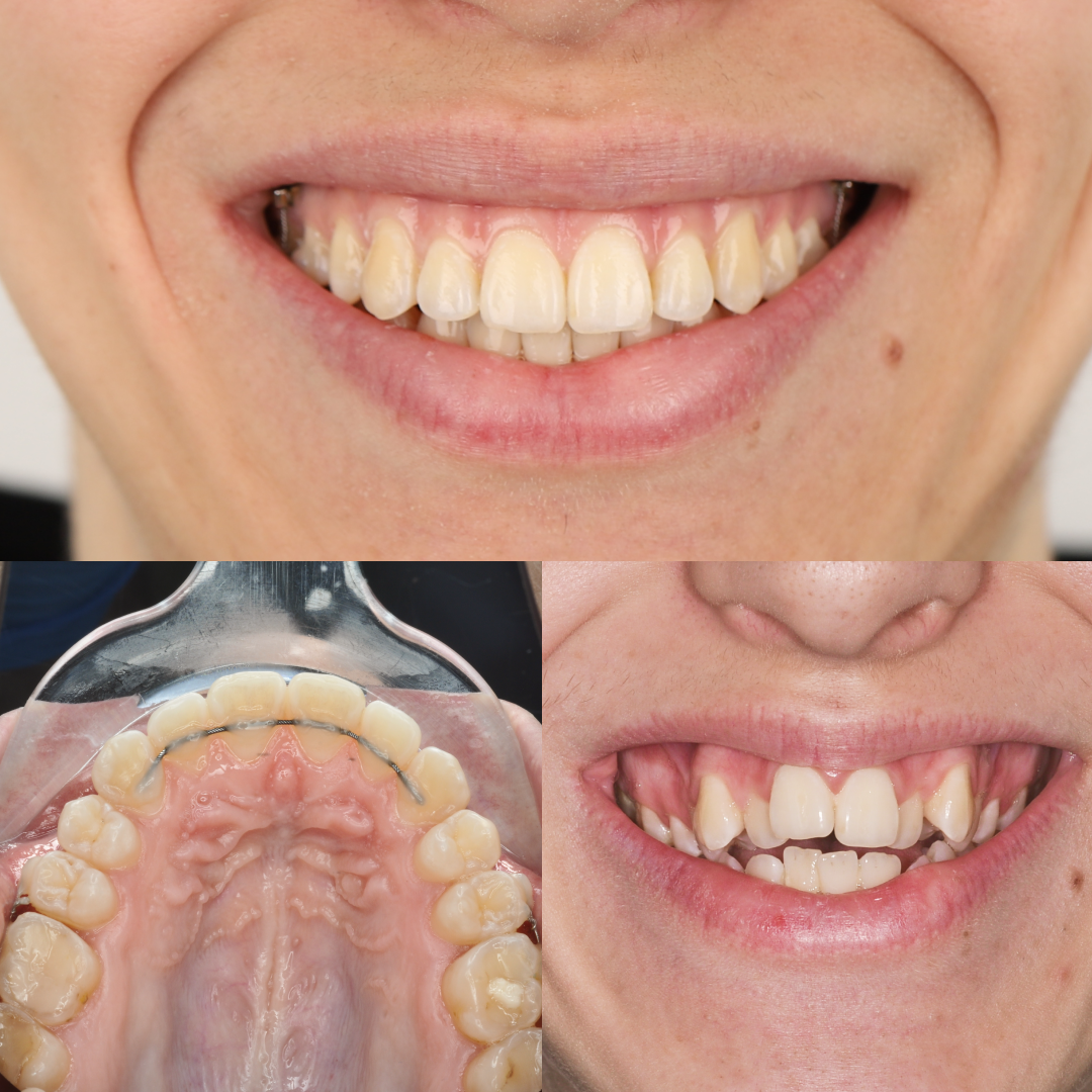 MARPE case result 4
