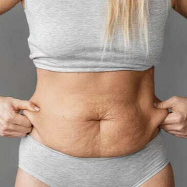 Как подтянуть кожу после похудения