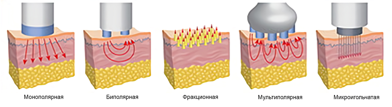 RF-лифтинг
