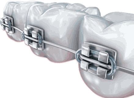 Протезы передних зубов в стоматологии Барышева ☎ +7 (908) 237-73-77 