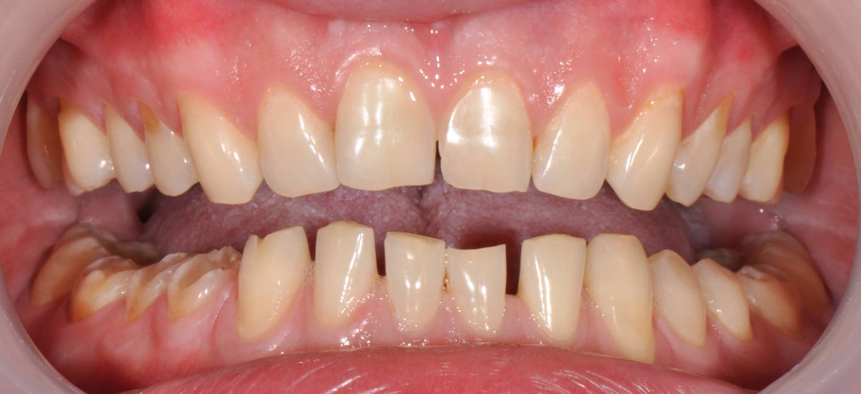В каких случаях проводится реставрация зубов?
