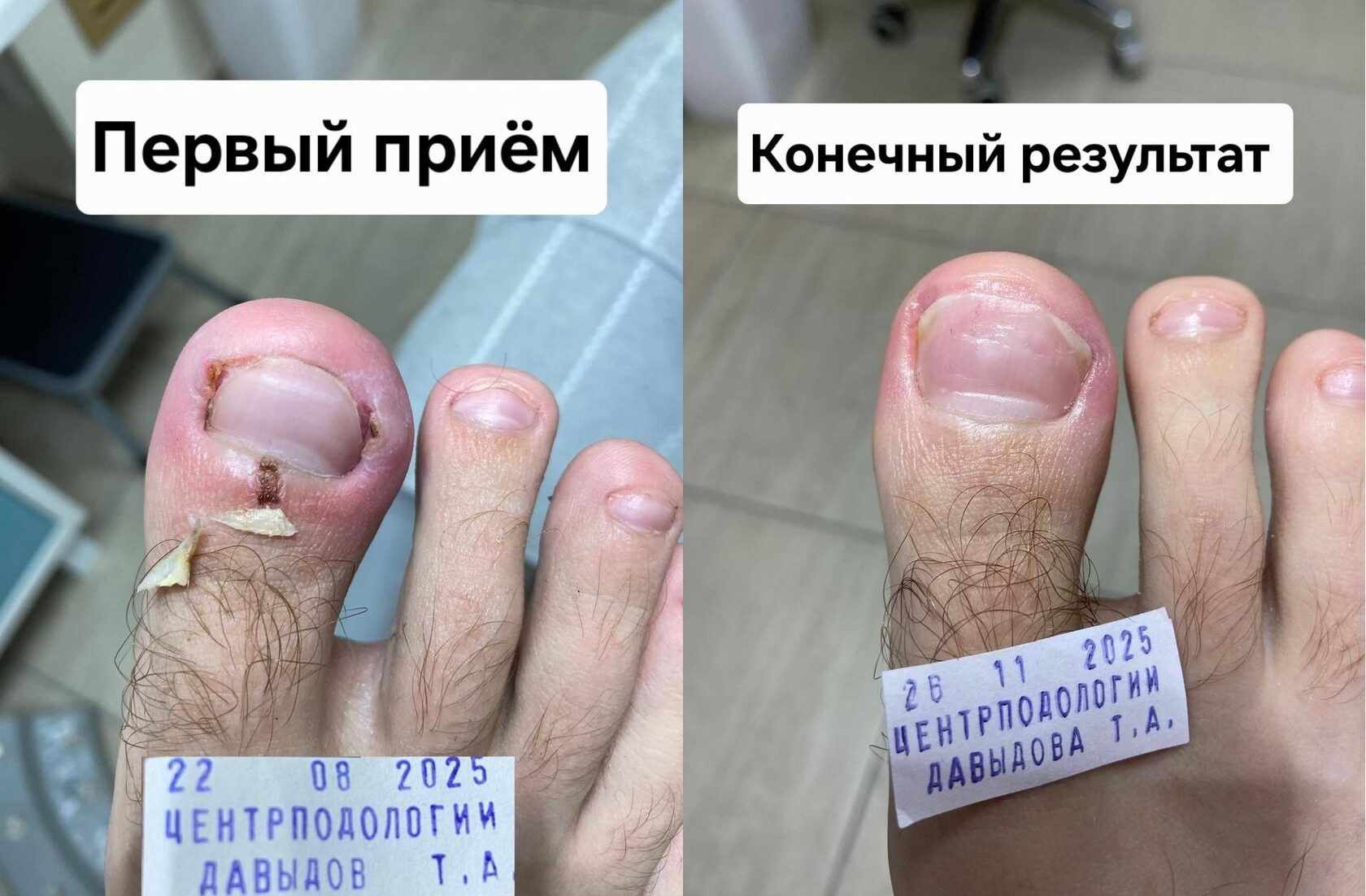 результаты лечения вросшего ногтя до и после