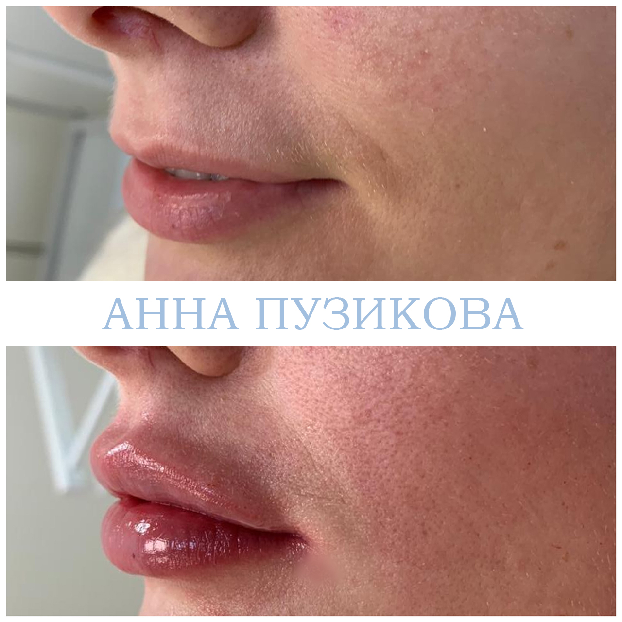 Контурная пластика губ гиалуроновым филлером — естественный результат без утраты пропорций. Косметолог Пузикова Анна Анатольевна, Санкт-Петербург.