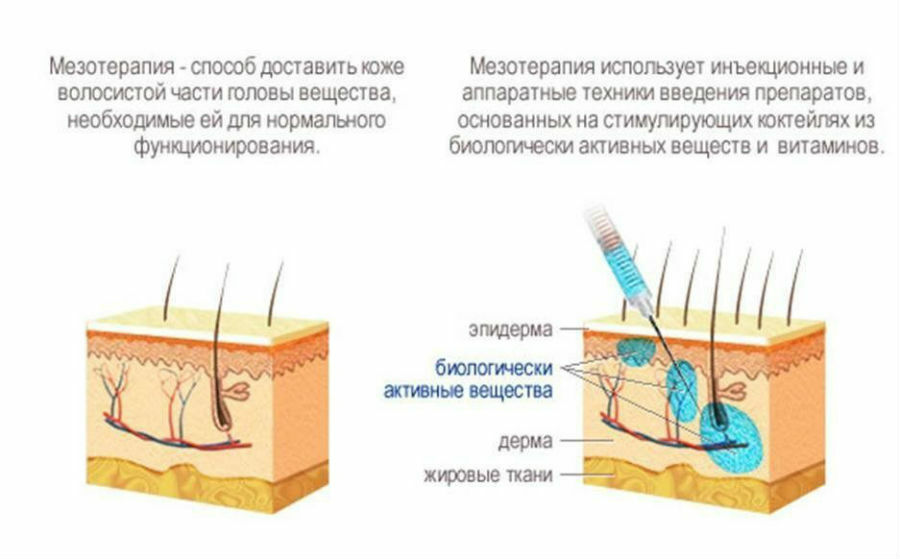 Проникновение компонентов мезококтейля в волосистую кожу головы
