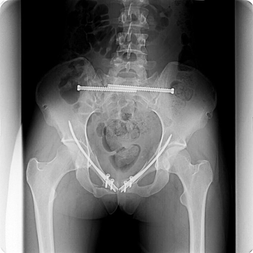 Трещина крестца. Чрескостный остеосинтез КПС илеосакральными винтами рентген. Оскольчатый перелом седалищной кости. Перелом лонного сочленения рентген.