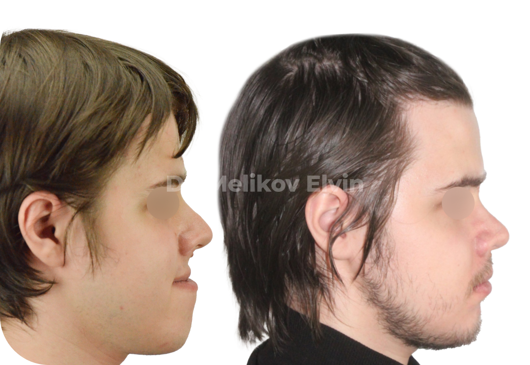 До и после ортогнатической операции при мезиальном прикусе