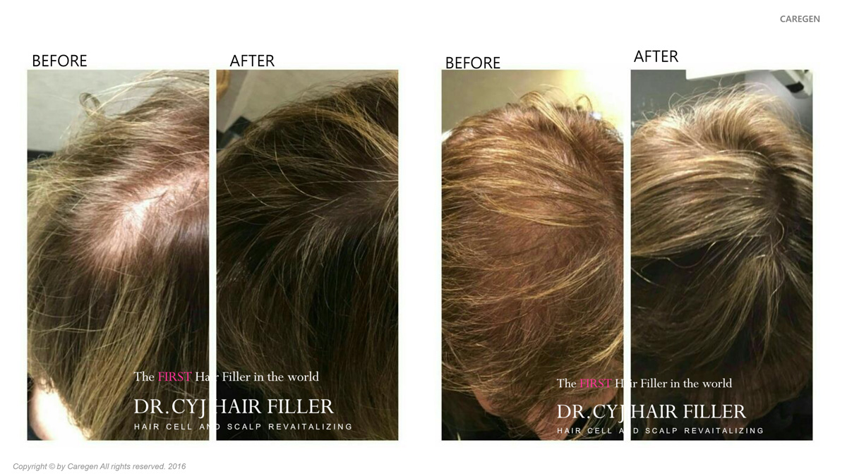 Phyto stem cell therapy (Hair filler therapy) – Silverine