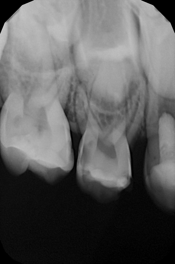 Лечение хронического пульпита с установкой коронки на зуб ребенку