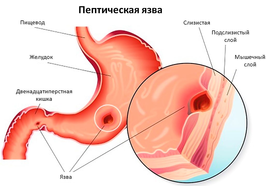 Язвенная болезнь двенадцатиперстной кишки картинки