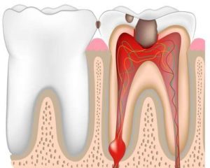 Болит тройничный нерв или зубы?