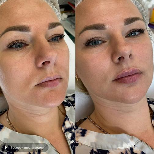 Контурная пластика губ